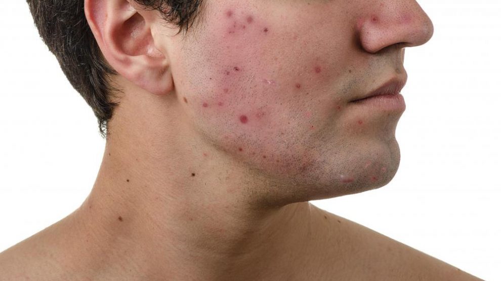 از شر جوش ها به پروبیوتیک ها پناه ببرید!